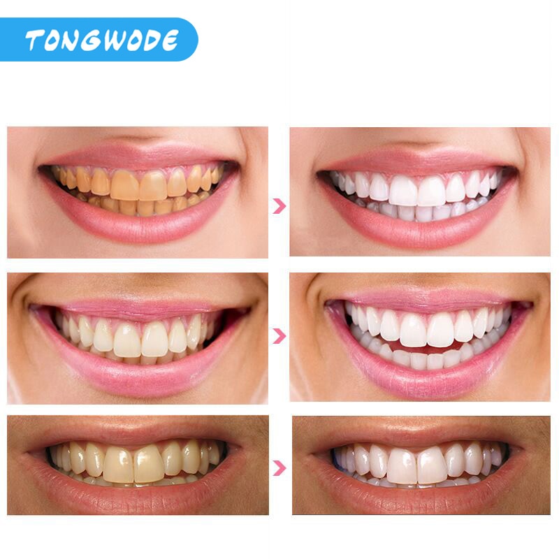 Fast Teeth Whitening Lamp With LED Light Dental Bleaching Set Tooth Stains Removal Tooth Whitening Equipment Oral Care