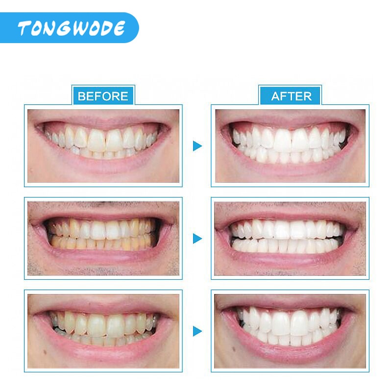 Fast Teeth Whitening Lamp With LED Light Dental Bleaching Set Tooth Stains Removal Tooth Whitening Equipment Oral Care