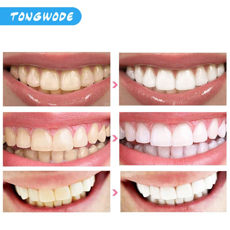 Fast Teeth Whitening Lamp With LED Light Dental Bleaching Set Tooth Stains Removal Tooth Whitening Equipment Oral Care